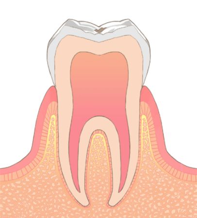 C2／象牙質のむし歯