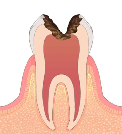 C4／歯根まで進行したむし歯