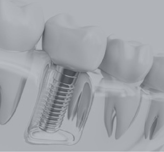 インプラント治療