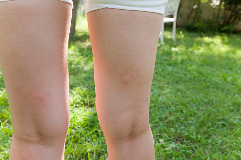 金属アレルギーなので銀歯が不安…